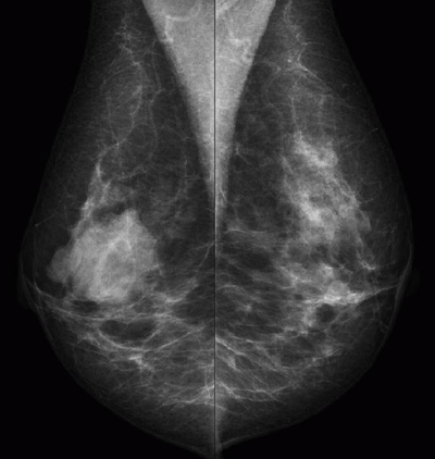 Bild Siloah St. Trudpert Klinikum, Radiologie, Mammographiebild