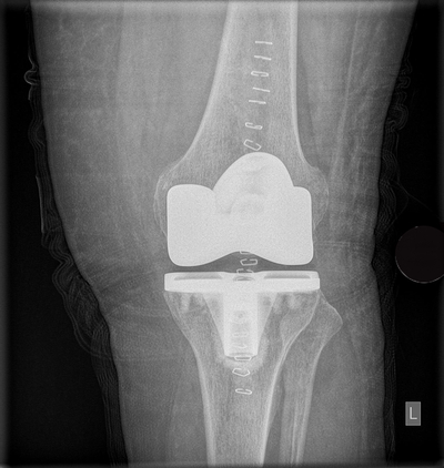 Knie-OP, Roentgenbild, Klinik für Orthopaedie und Unfallchirurgie